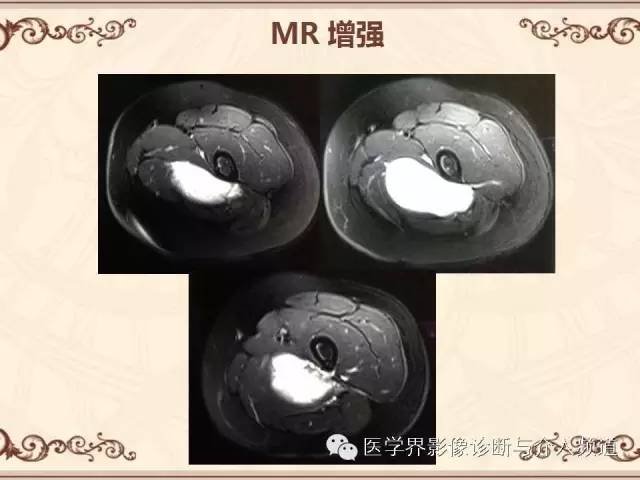 【病例】膝关节滑膜肉瘤1例MR影像表现