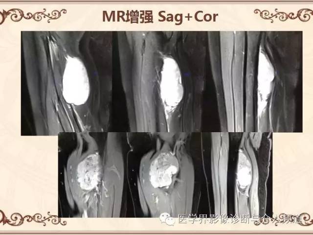 【病例】膝关节滑膜肉瘤1例MR影像表现