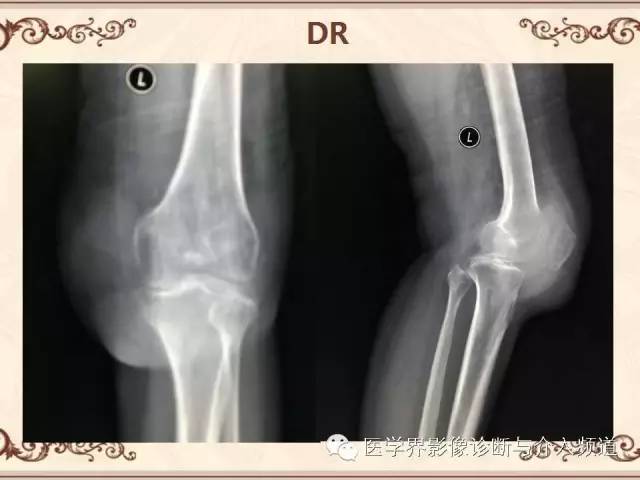 【病例】膝关节滑膜肉瘤1例MR影像表现