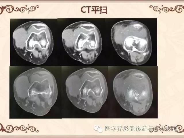 【病例】膝关节滑膜肉瘤1例MR影像表现