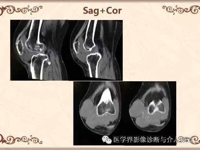 【病例】膝关节滑膜肉瘤1例MR影像表现