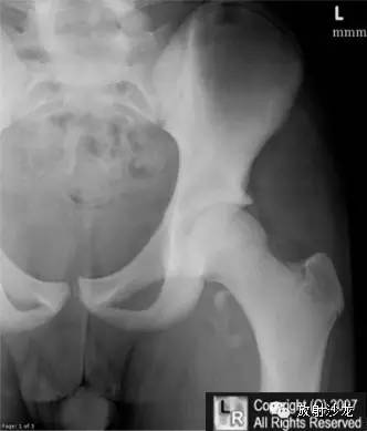 【病例】股骨小转子撕脱骨折X线1例