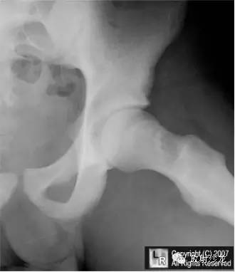 【病例】股骨小转子撕脱骨折X线1例