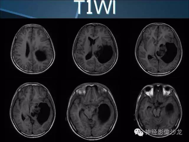 【病例】幕上毛细胞星形细胞瘤1例MR影像表现