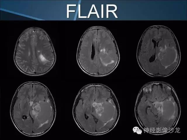 【病例】幕上毛细胞星形细胞瘤1例MR影像表现