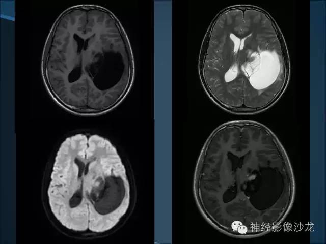 【病例】幕上毛细胞星形细胞瘤1例MR影像表现