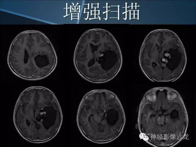 【病例】幕上毛细胞星形细胞瘤1例MR影像表现
