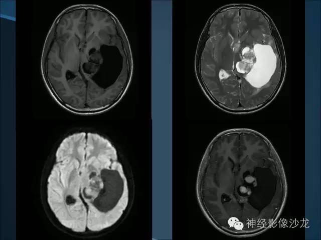 【病例】幕上毛细胞星形细胞瘤1例MR影像表现