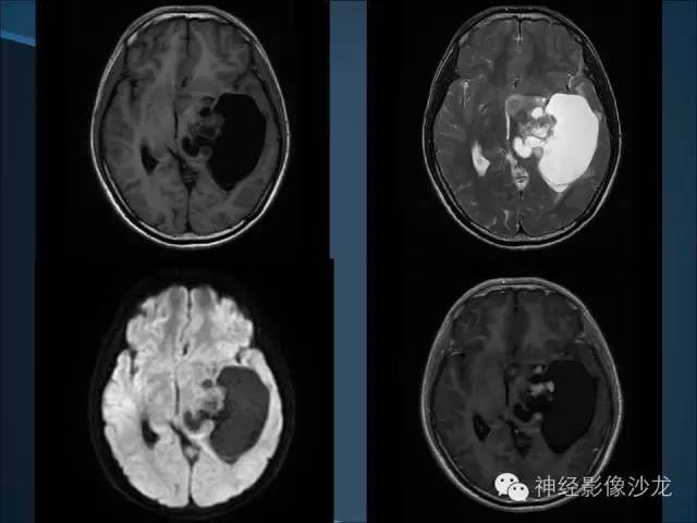 【病例】幕上毛细胞星形细胞瘤1例MR影像表现