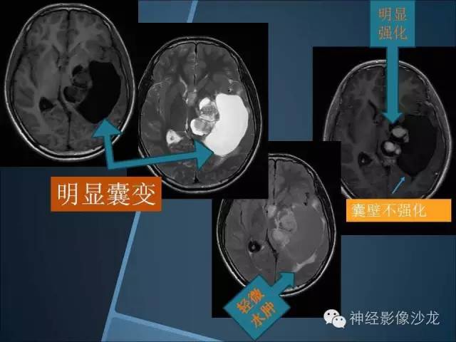 【病例】幕上毛细胞星形细胞瘤1例MR影像表现