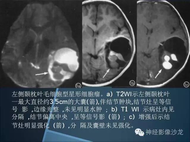 【病例】幕上毛细胞星形细胞瘤1例MR影像表现