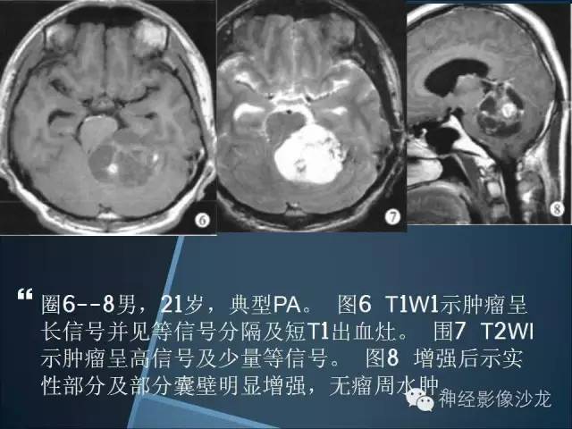【病例】幕上毛细胞星形细胞瘤1例MR影像表现