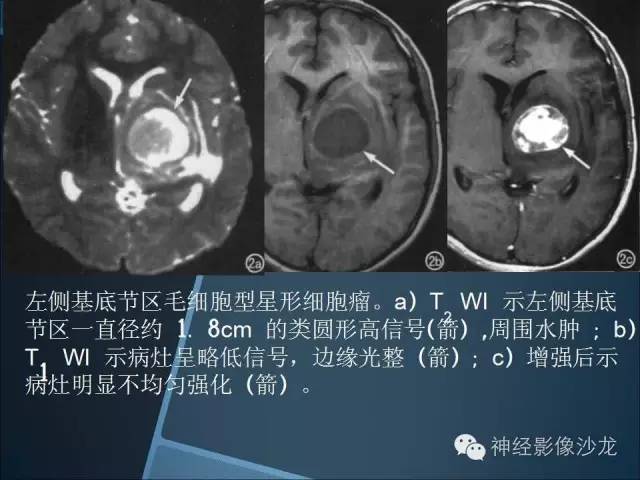 【病例】幕上毛细胞星形细胞瘤1例MR影像表现