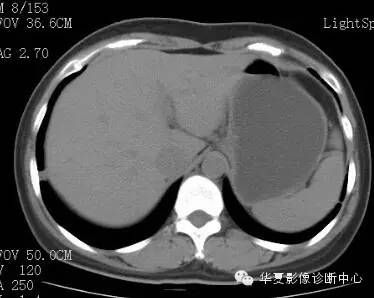 【病例】胰周淋巴结结核1例CT影像表现 【病例】胰周淋巴结结核1例CT影像表现