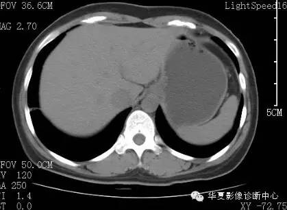 【病例】胰周淋巴结结核1例CT影像表现