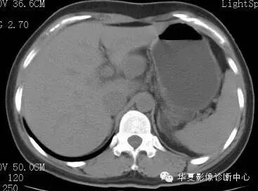 【病例】胰周淋巴结结核1例CT影像表现 【病例】胰周淋巴结结核1例CT影像表现