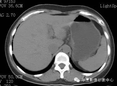 【病例】胰周淋巴结结核1例CT影像表现 【病例】胰周淋巴结结核1例CT影像表现