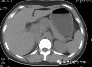 【病例】胰周淋巴结结核1例CT影像表现 【病例】胰周淋巴结结核1例CT影像表现