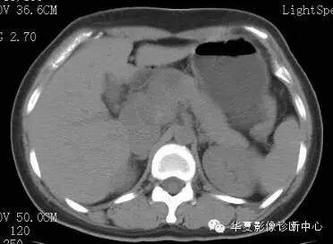 【病例】胰周淋巴结结核1例CT影像表现 【病例】胰周淋巴结结核1例CT影像表现