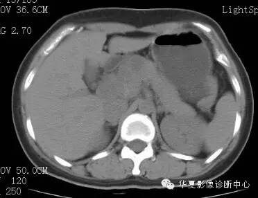 【病例】胰周淋巴结结核1例CT影像表现 【病例】胰周淋巴结结核1例CT影像表现