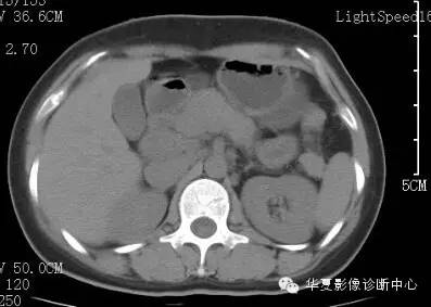 【病例】胰周淋巴结结核1例CT影像表现 【病例】胰周淋巴结结核1例CT影像表现