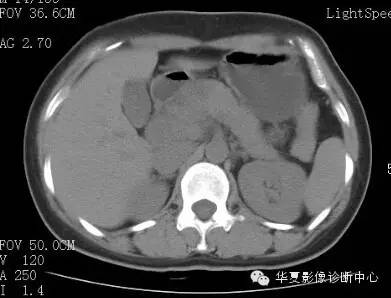 【病例】胰周淋巴结结核1例CT影像表现 【病例】胰周淋巴结结核1例CT影像表现