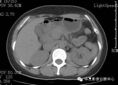 【病例】胰周淋巴结结核1例CT影像表现 【病例】胰周淋巴结结核1例CT影像表现