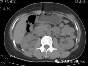 【病例】胰周淋巴结结核1例CT影像表现 【病例】胰周淋巴结结核1例CT影像表现