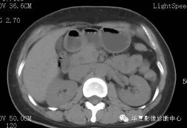 【病例】胰周淋巴结结核1例CT影像表现 【病例】胰周淋巴结结核1例CT影像表现