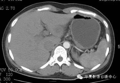 【病例】胰周淋巴结结核1例CT影像表现 【病例】胰周淋巴结结核1例CT影像表现
