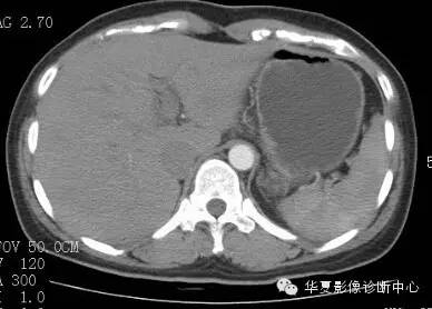 【病例】胰周淋巴结结核1例CT影像表现 【病例】胰周淋巴结结核1例CT影像表现