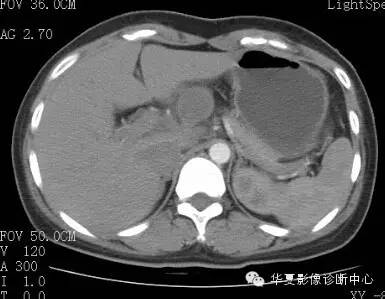 【病例】胰周淋巴结结核1例CT影像表现 【病例】胰周淋巴结结核1例CT影像表现