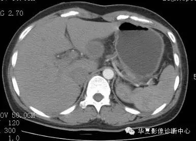 【病例】胰周淋巴结结核1例CT影像表现 【病例】胰周淋巴结结核1例CT影像表现