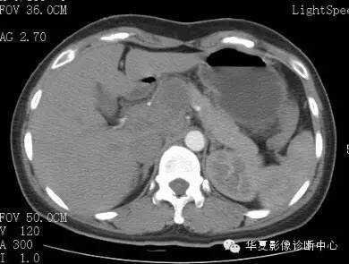 【病例】胰周淋巴结结核1例CT影像表现 【病例】胰周淋巴结结核1例CT影像表现