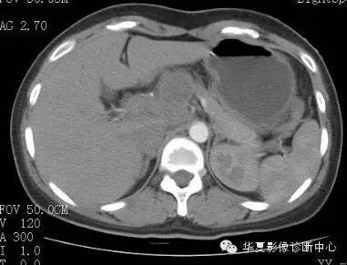 【病例】胰周淋巴结结核1例CT影像表现 【病例】胰周淋巴结结核1例CT影像表现