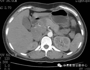 【病例】胰周淋巴结结核1例CT影像表现 【病例】胰周淋巴结结核1例CT影像表现