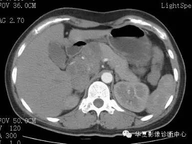 【病例】胰周淋巴结结核1例CT影像表现 【病例】胰周淋巴结结核1例CT影像表现