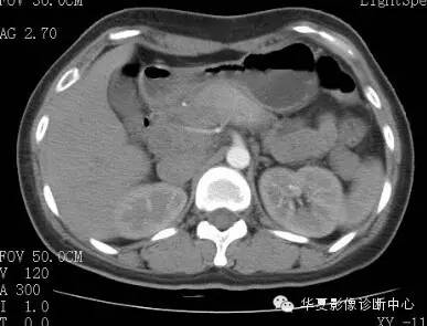 【病例】胰周淋巴结结核1例CT影像表现 【病例】胰周淋巴结结核1例CT影像表现