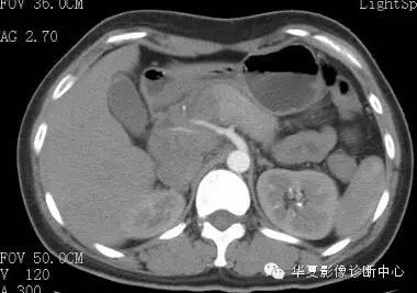 【病例】胰周淋巴结结核1例CT影像表现 【病例】胰周淋巴结结核1例CT影像表现