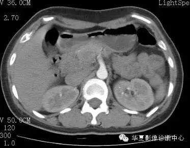【病例】胰周淋巴结结核1例CT影像表现 【病例】胰周淋巴结结核1例CT影像表现