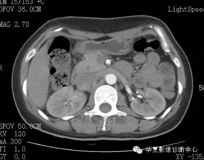 【病例】胰周淋巴结结核1例CT影像表现 【病例】胰周淋巴结结核1例CT影像表现