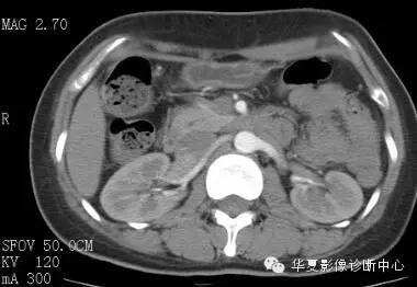 【病例】胰周淋巴结结核1例CT影像表现 【病例】胰周淋巴结结核1例CT影像表现