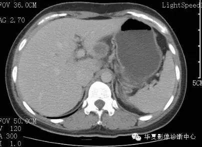 【病例】胰周淋巴结结核1例CT影像表现 【病例】胰周淋巴结结核1例CT影像表现