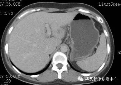 【病例】胰周淋巴结结核1例CT影像表现 【病例】胰周淋巴结结核1例CT影像表现