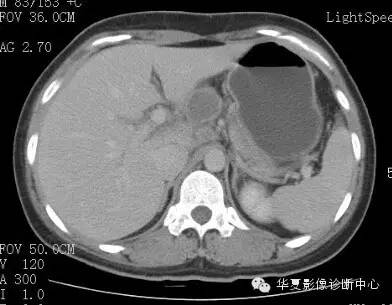 【病例】胰周淋巴结结核1例CT影像表现 【病例】胰周淋巴结结核1例CT影像表现