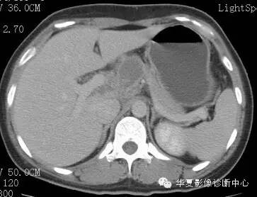 【病例】胰周淋巴结结核1例CT影像表现 【病例】胰周淋巴结结核1例CT影像表现