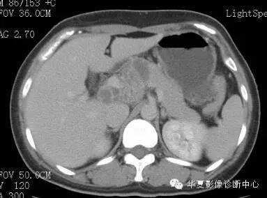 【病例】胰周淋巴结结核1例CT影像表现 【病例】胰周淋巴结结核1例CT影像表现