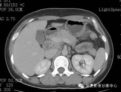 【病例】胰周淋巴结结核1例CT影像表现 【病例】胰周淋巴结结核1例CT影像表现