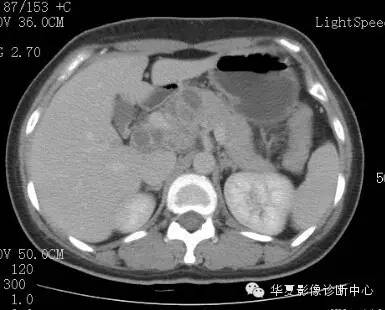 【病例】胰周淋巴结结核1例CT影像表现 【病例】胰周淋巴结结核1例CT影像表现