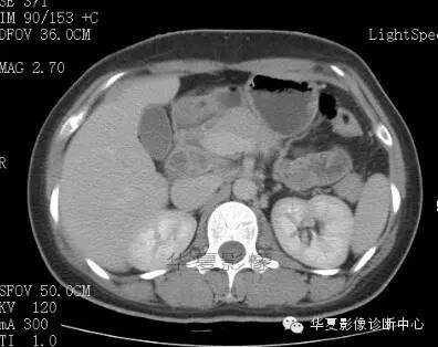 【病例】胰周淋巴结结核1例CT影像表现 【病例】胰周淋巴结结核1例CT影像表现